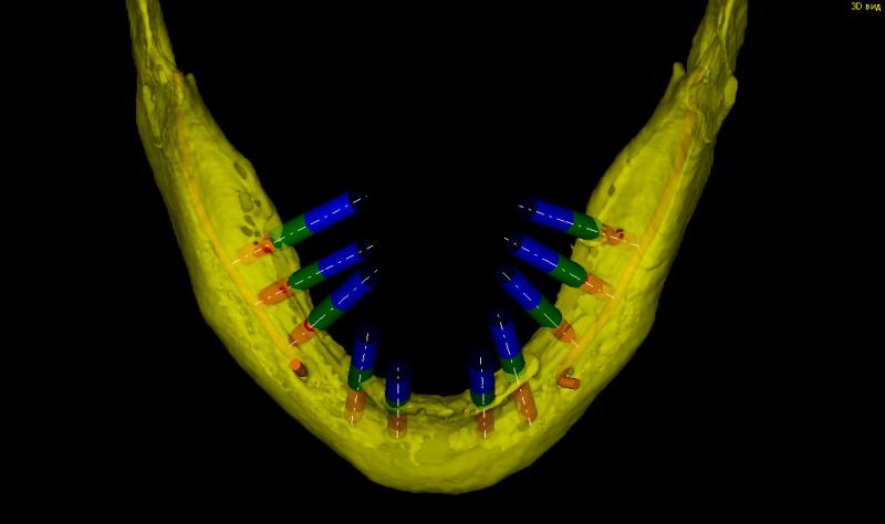 Планирование установки имплантантов на компьютере  3D вид сверху